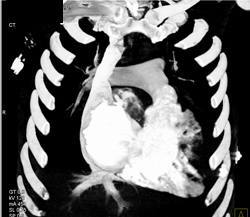 Normal Pulmonary Artery - CTisus CT Scan