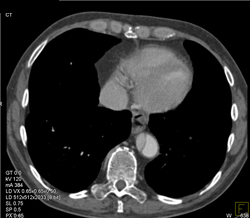 Aortic Dissection Into Arch Vessels - CTisus CT Scan