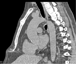 Non Contrast CT for Aortic Root - CTisus CT Scan