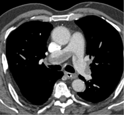 Huge Pulmonary Emboli (PEs) - CTisus CT Scan