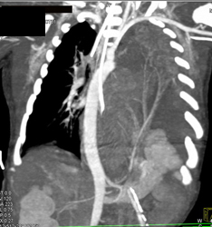 Congenital Diaphragmatic Hernia - CTisus CT Scan