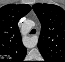 Right Sided Arch and Aberrant Left Subclavian Artery - CTisus CT Scan