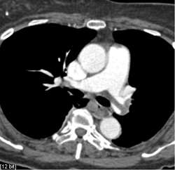 Thrombus in Pulmonary Artery and Right Atrium - CTisus CT Scan