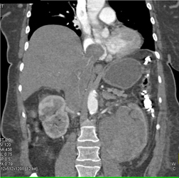 Renal Cell Carcinoma Invades the Inferior Vena Cava (IVC) and Extends Into Right Atrium - CTisus CT Scan