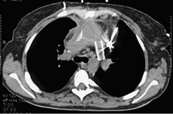 Stent in Left Pulmonary Artery - CTisus CT Scan