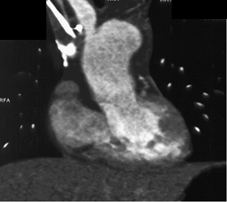 Clot in Right Innominate Vein - CTisus CT Scan