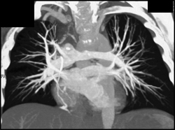 MIP of Pulmonary Blood Flow - CTisus CT Scan