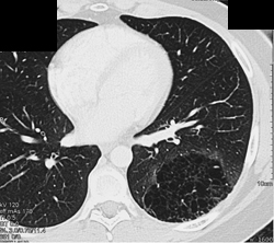 Sequestration - CTisus CT Scan