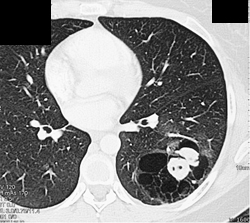 Sequestration - CTisus CT Scan