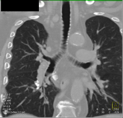 Virtual Bronchoscopy With Granulomatous Disease - CTisus CT Scan