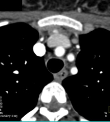 Normal Arch Vessels and Left I.m. Node - CTisus CT Scan