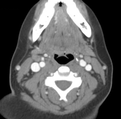 Normal Carotid Vessels - CTisus CT Scan