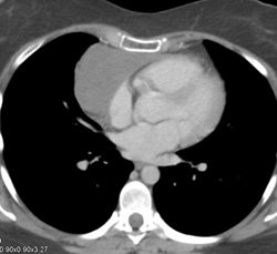 Large Thymus - CTisus CT Scan