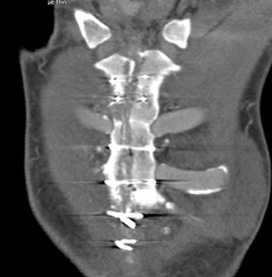 Sternal Osteomyelitis - CTisus CT Scan