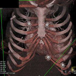 Normal Sternum - CTisus CT Scan