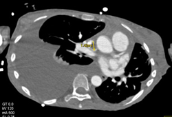 Clot in SVC Near Catheter - CTisus CT Scan