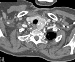 Substernal Thyroid Goiter - CTisus CT Scan