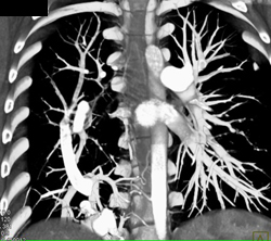 Scimtar Syndrome With Prior Embolization - CTisus CT Scan