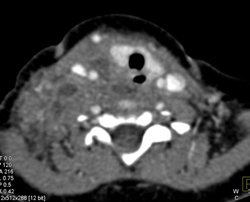 Mediastinal and Supraclavicular Abscess - CTisus CT Scan