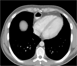 Colon Interposition - CTisus CT Scan