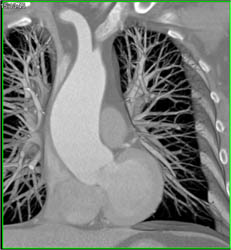 Dilated Aortic Root - CTisus CT Scan