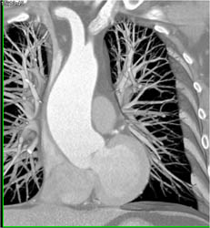 Dilated Aortic Root - CTisus CT Scan