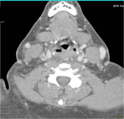 SVC Thrombus Extends Into Jugular Vein - CTisus CT Scan