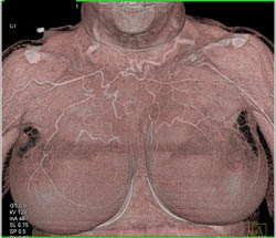 Collaterals on Chest Wall - CTisus CT Scan