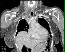 Occluded Catheter in Right Subclavian Artery - CTisus CT Scan