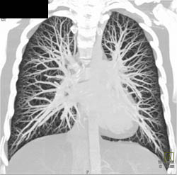 Normal Pulmonary Vascularity - CTisus CT Scan