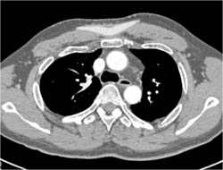 Prosthetic in Chest Wall to Fix Pectus Deformity - CTisus CT Scan