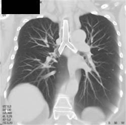 Patent Stent in Airway With Multiple 3D Views - CTisus CT Scan