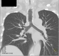 Stent in Airway With Granulomatous Tissue Pushing on Right Side of Trachea at Bifurcation- Various Renderings - CTisus CT Scan