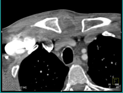 Infection at Right S/c Joint - CTisus CT Scan