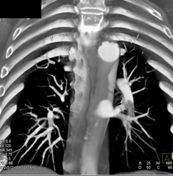 Pulmonary Embolism - CTisus CT Scan