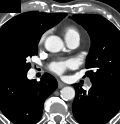 Pulmonary Embolism - CTisus CT Scan