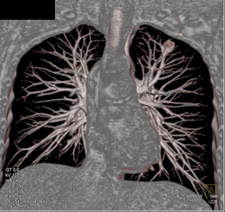 Cavitary Lung Lesion - CTisus CT Scan