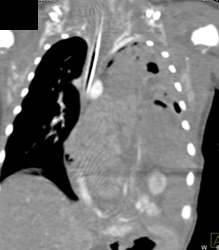 Ruptured Diaphragm With Bowel Herniating Into the Chest - CTisus CT Scan