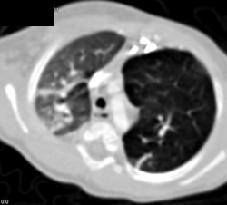 Congenital Lobar Emphysema - CTisus CT Scan