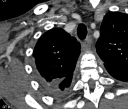 Clotted Stent in Axillary Artery - CTisus CT Scan