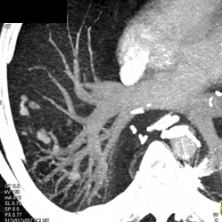 Embolized Pulmonary Arteriovenous Malformation (PAVM) - CTisus CT Scan