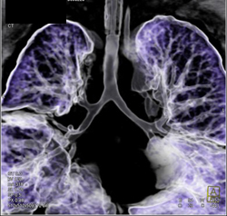 Narrowed Airway Mainstem Bronchi - CTisus CT Scan