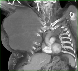 Chordoma Involves the Chest Wall - CTisus CT Scan