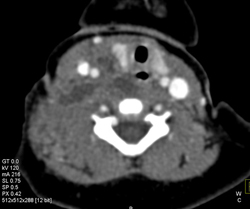 Neck Abscess - CTisus CT Scan