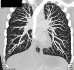 Pulmonary Arteriovenous Malformation (PAVM) in Left Lower Lung - CTisus CT Scan