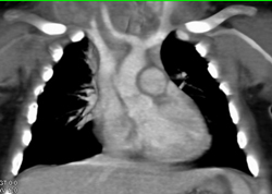 Carotid Off Arch - CTisus CT Scan