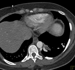 Sequestration Left Lower Lung - CTisus CT Scan