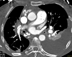 Thrombus in Atrial Appendage - CTisus CT Scan