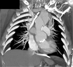 Pseudoaneurysm Off Ascending Aorta With SVC Compression - CTisus CT Scan