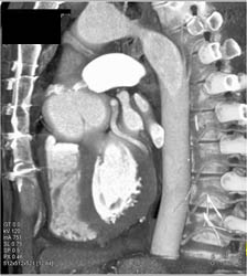 Dilated Sinus of Valsalva - CTisus CT Scan